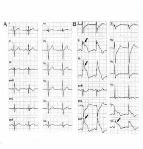 阿斯綜合症 阿斯綜合症