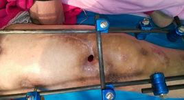 股骨骨髓炎 股骨骨髓炎