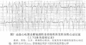 病理性陣發性室性心動過速