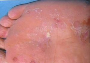 腳癬 腳癬