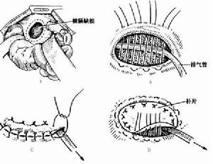 先天性胸腹裂孔疝