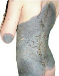 先天性巨痣 先天性巨痣