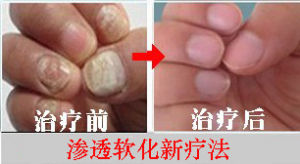 滲透軟化新療法 滲透軟化新療法