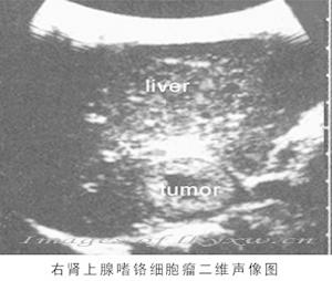 高山紅細胞增多症