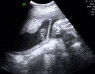 輪狀胎盤 輪狀胎盤