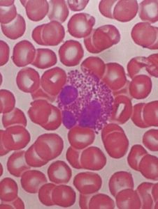 粒細胞減少症 粒細胞減少症