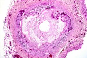 血管鈣化 血管鈣化