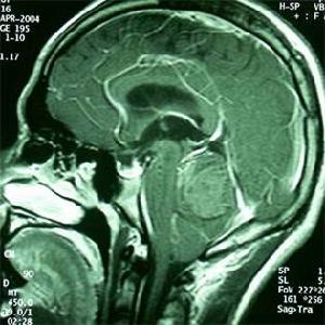 顱內壓增高綜合症