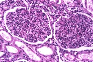 急性瀰漫性增生性腎小球腎炎