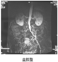 動脈硬化性閉塞症