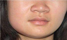 流行性腮腺炎 流行性腮腺炎