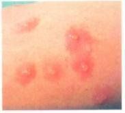 黑布拉痒疹 黑布拉痒疹