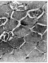脂質沉積性肌病