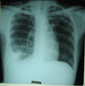 急性滲出性胸膜炎