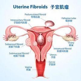 孕期子宮肌瘤