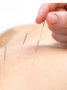 針灸治療肩周炎 針灸治療肩周炎