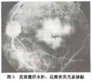 視網膜靜脈阻塞