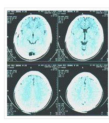 腦性癱瘓 腦性癱瘓