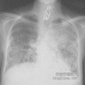 枸櫞酸桿菌肺炎