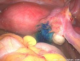 藥流人流 藥流人流