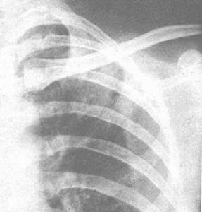 慢性嗜酸粒細胞性肺炎