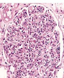瀰漫性腎病 瀰漫性腎病