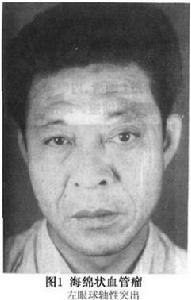 眶內海綿狀血管瘤