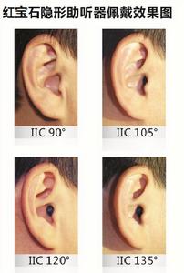 紅寶石隱形助聽器佩戴效果圖