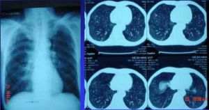 卡氏肺囊蟲肺炎