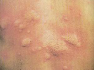（圖）過敏性蕁麻疹