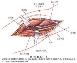 尺側腕屈肌移位術 尺側腕屈肌移位術