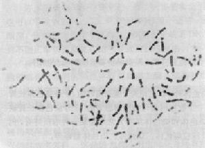 染色體異常伴發的精神障礙