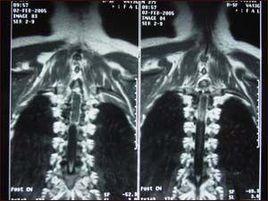 脊髓髓內腫瘤切除術 脊髓髓內腫瘤切除術