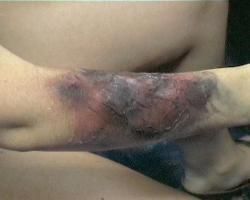 燒傷敗血症 燒傷敗血症