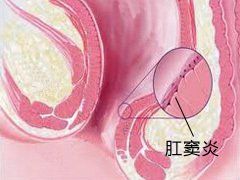 肛竇 肛竇