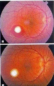 弓形體病性鞏膜炎 弓形體病性鞏膜炎