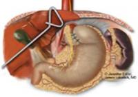 缺鐵性吞咽困難