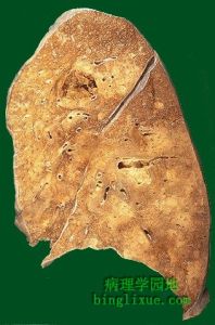 肺炎克雷白桿菌肺炎