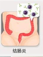 潰瘍性結腸炎中醫診斷與治療 潰瘍性結腸炎中醫診斷與治療