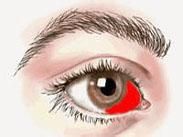 白睛溢血 白睛溢血