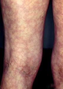 紅瘡狼斑 紅瘡狼斑