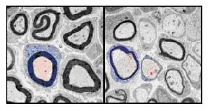 亨廷頓病性痴呆