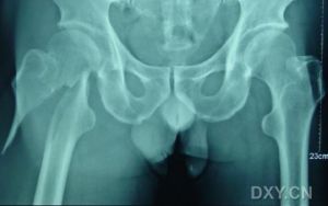 股骨粗隆間骨折