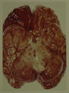 小兒化膿性腦膜炎