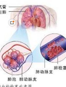 肺血栓栓塞症