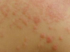 蟎蟲過敏症 蟎蟲過敏症