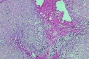 Barret食管 Barret食管