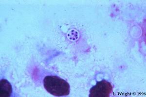 卡氏肺孢子蟲病