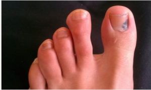 腳趾甲黑色素瘤 腳趾甲黑色素瘤