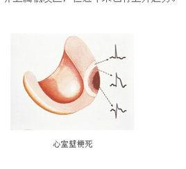 急性心肌梗死灶顯像 急性心肌梗死灶顯像